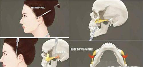 一、鼻中隔软骨