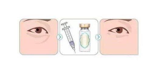 五、女生关注茶包去眼袋的理性看待