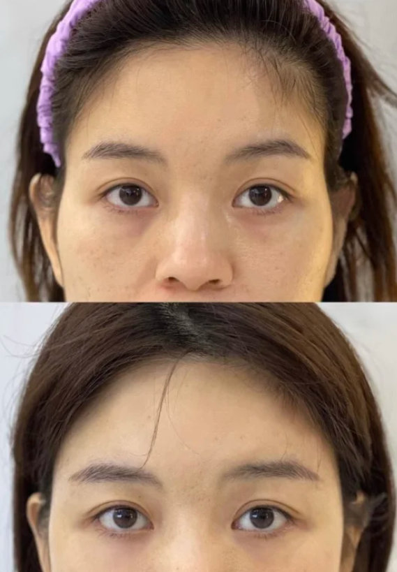 四、隆鼻热敷用毛巾还是棉签