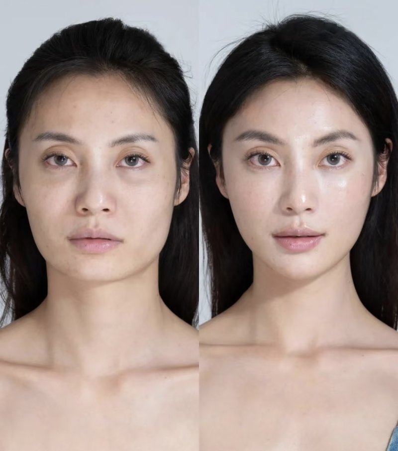 二、天生双眼皮消失的核心诱因：上睑松弛引发的上睑下垂