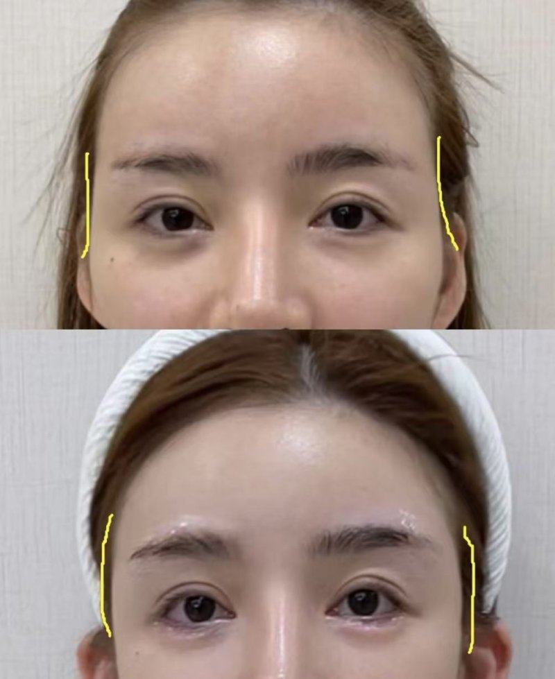 四、正确的眼袋按摩操作步骤