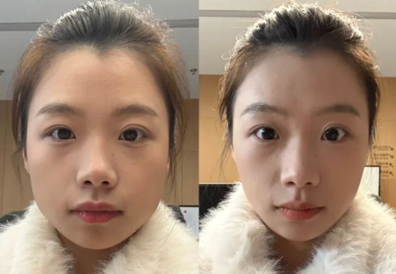 三、双眼皮淤青怎么消得快的细节把控