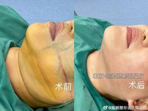 泰国Bangkok曼谷整形外科诊所价格表: