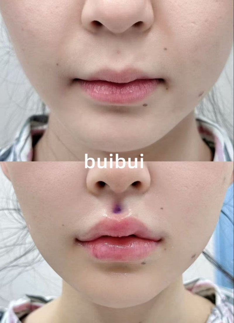 四、选择一万多假体隆胸的避坑实用指南