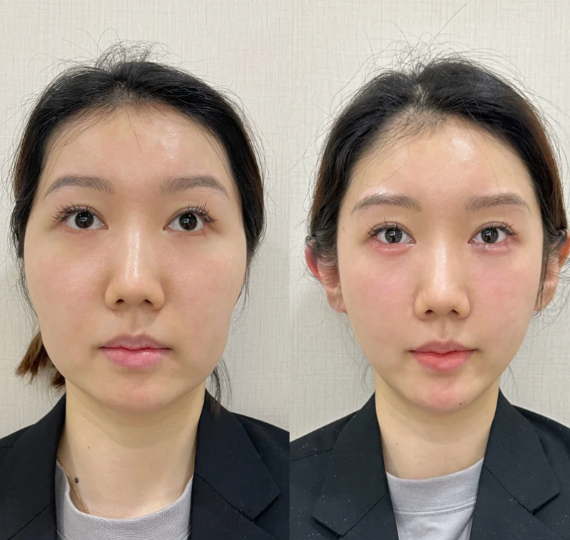 二、不同激光类型对应的适配疤痕方案