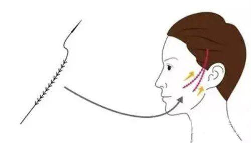 四、腹部吸脂手术安心吗