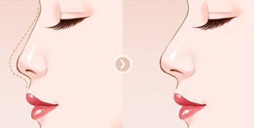 三、做腹部吸脂手术好吗女性