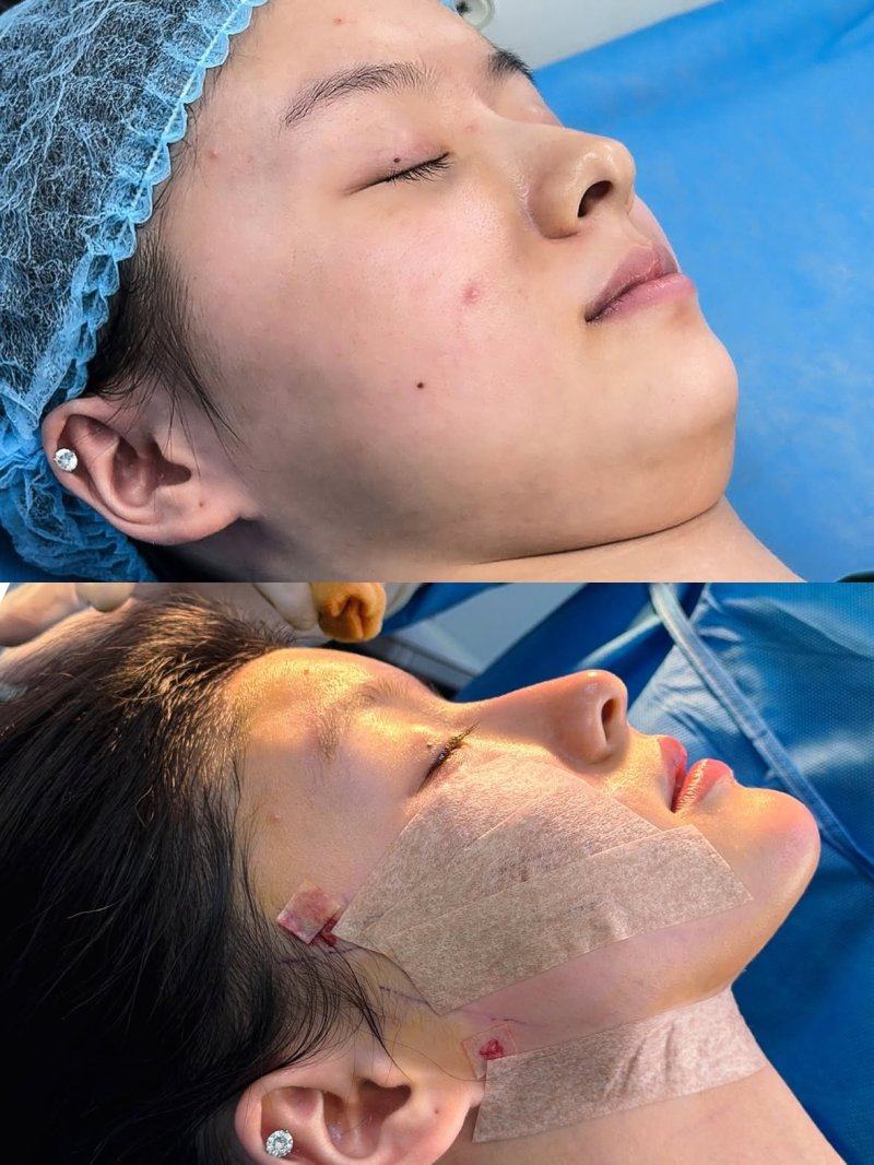 四、腹部吸脂术的危害远不止表面问题,致命风险需警惕