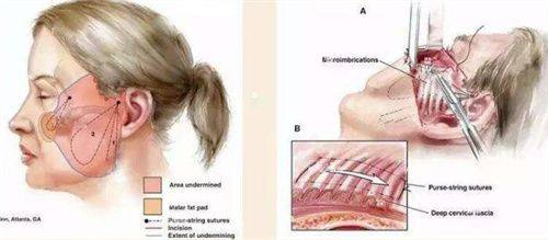 二、不同疤痕类型的激光祛疤适配方案与成效