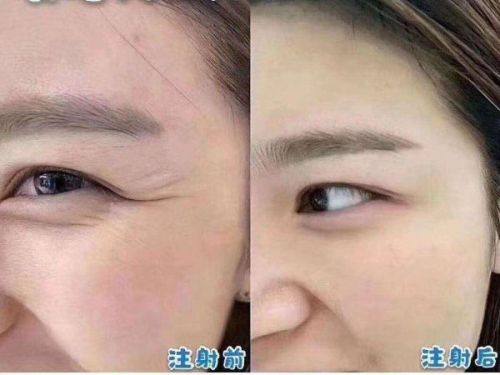 结尾：五厘米疤痕凹凸不平的修复总结