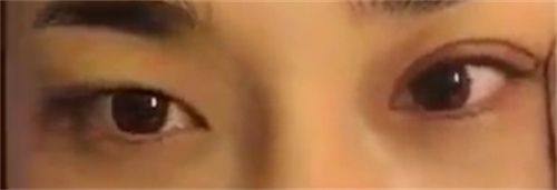 三、激光祛疤的单次费用与疗程安排