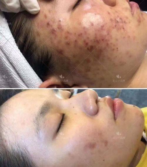 亳州市中医院皮肤科擅长项目：