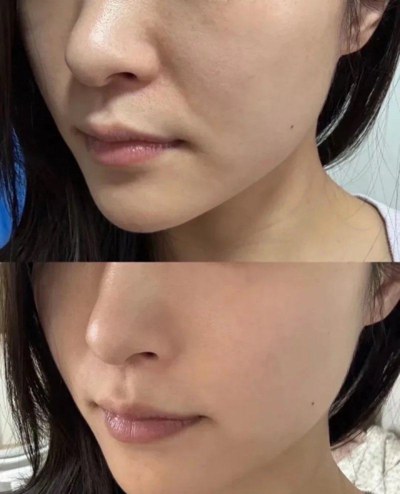 四、点阵激光后感觉疤痕更明显了是怎么回事