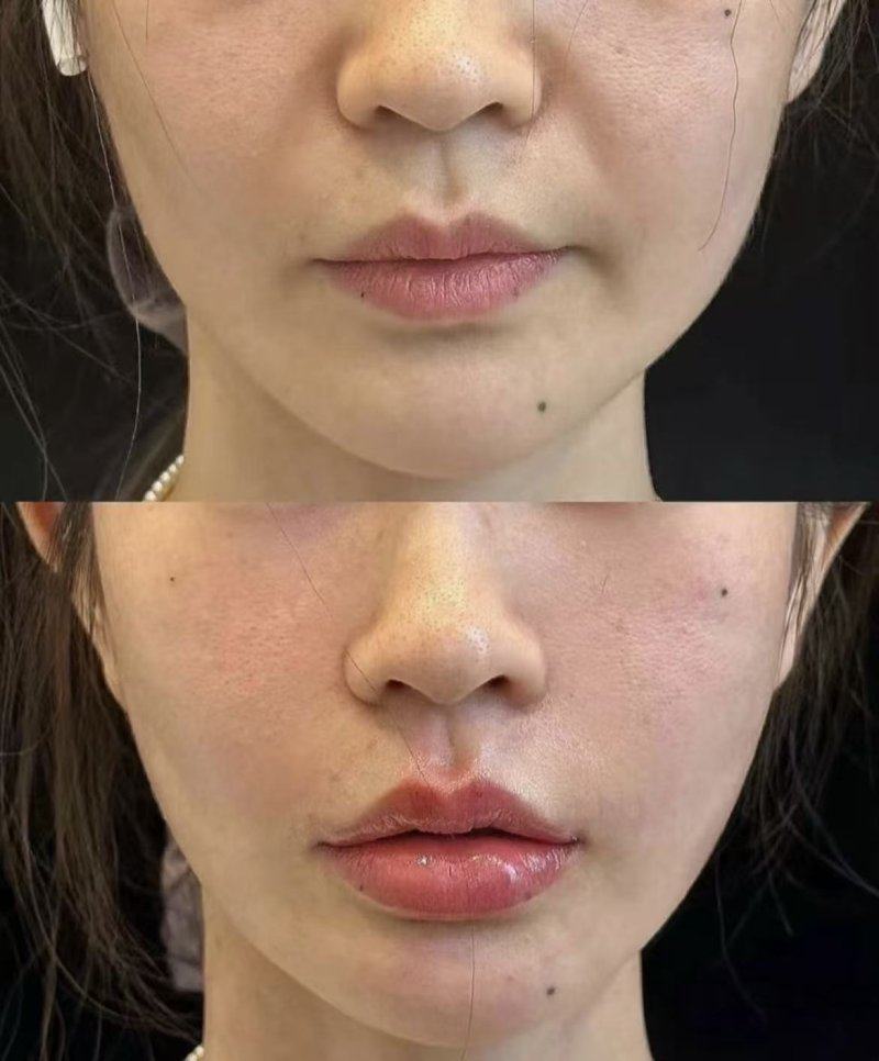 二、为什么部分患者点阵激光后疤痕反而更凸