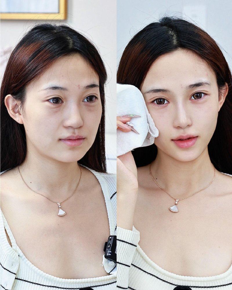 四、增生性五厘米凹凸疤痕修复方案及费用